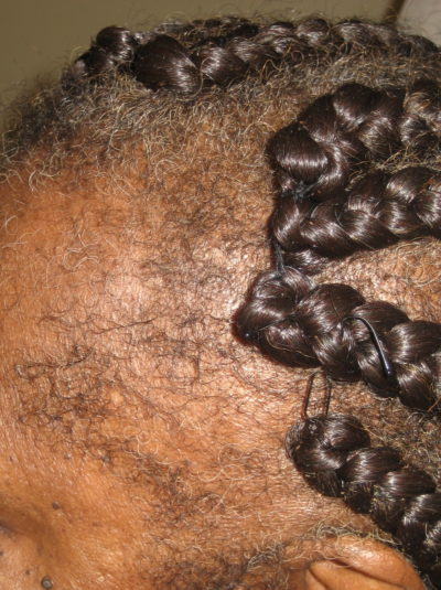 Traction Alopecia - MDhairmixtress.com