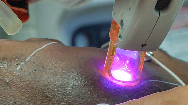 Hair Removal Magic What Black Women Need To Know About Laser Hair