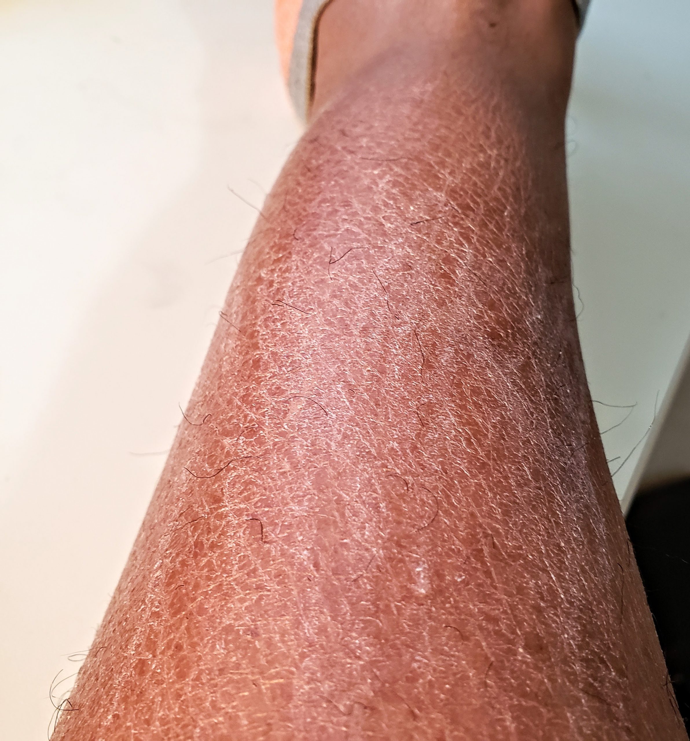 chapped skin on legs
